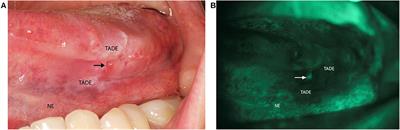 Amplification of 3q26.2, 5q14.3, 8q24.3, 8q22.3, and 14q32.33 Are Possible Common Genetic Alterations in Oral Cancer Patients